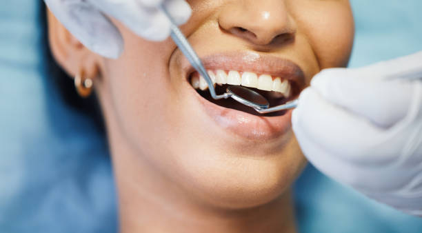 Best Emergency Dentist for Lost Fillings or Crowns in Rochester, IN