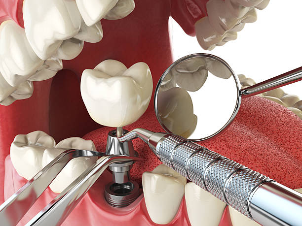 Best Emergency Dentist for Knocked-Out Tooth in Rochester, IN